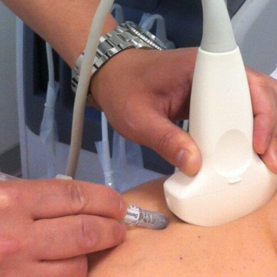 Infiltrazioni Ecoguidate all’Anca